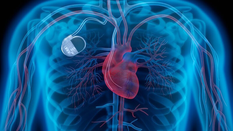 Wissenswertes zur Implantation eines Kardioverter-Defibrillators
