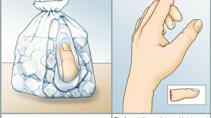 Wissenswertes zu Fingerprothesen