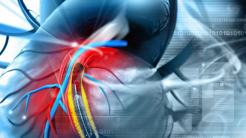 Die perkutane transluminale Angioplastie dient zur Erweiterung verengter Blutgefäße