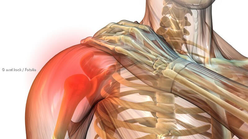 ᐅ Impingement-Syndrom der Schulter