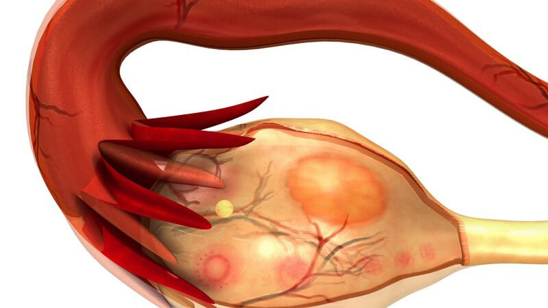 Zu den häufigsten Auslösern einer Eierstockzyste zählen Hormonstörungen