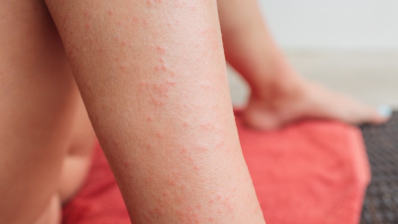 Dermatitis herpetiformis Duhring am Bein