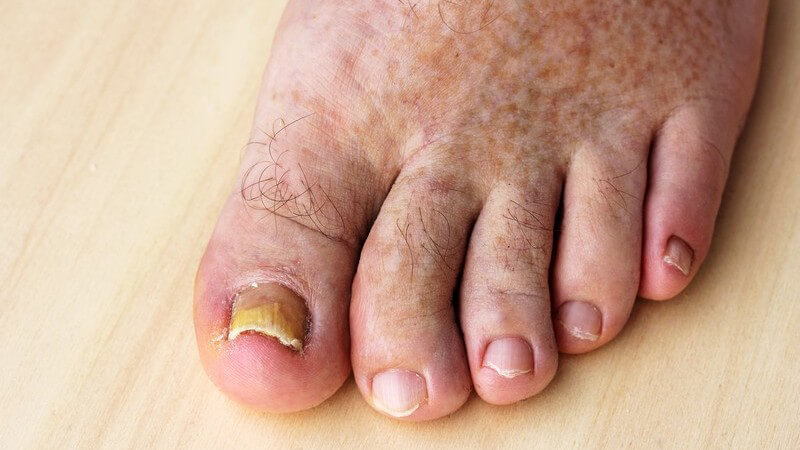 Zu den besonders weit verbreiteten Erkrankungen zählen der Fuß- und der Nagelpilz - zur Übertragung einer Dermatophytose kommt es durch Kontakt mit den Pilzsporen
