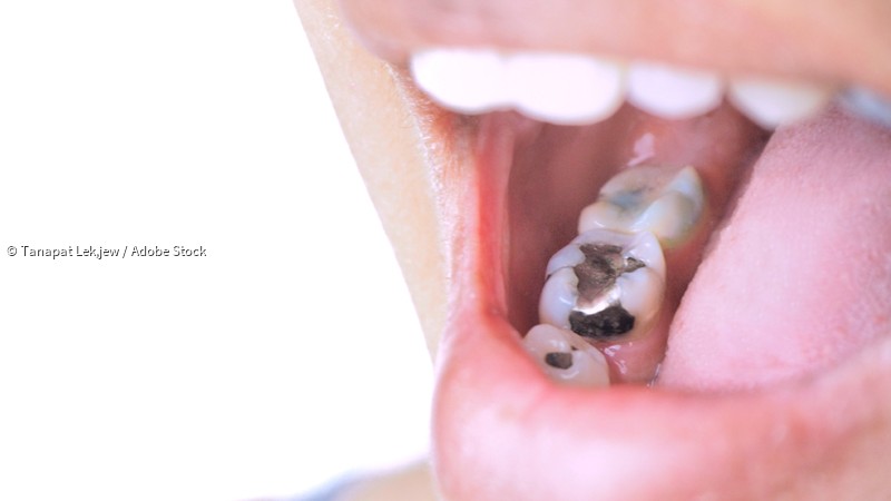 Wie lange dauert bis Amalgam aus dem Körper weg? Wie lange dauert bis Amalgam aus dem Körper weg?