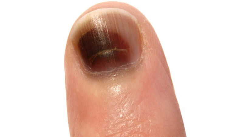 Wissenswertes zum Yellow-nail-Syndrom