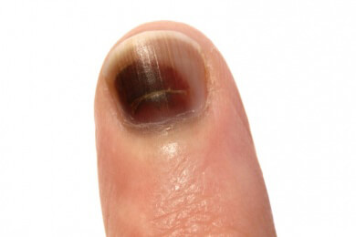 Wissenswertes über Längsrillen in Nägeln