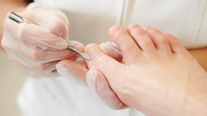 Wissenswertes zu Nagelpsoriasis