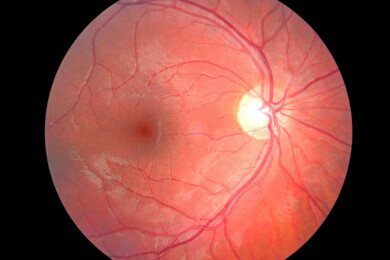 Diabetische Retinopathie - Ursachen, Symptome und Behandlung
