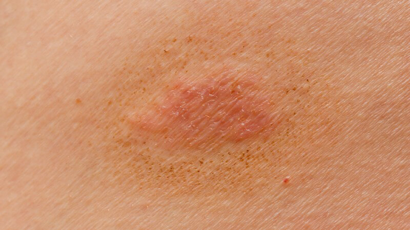 Die Entstehung von Hautpilz und wie man eine Dermatomykose erkennen und behandeln kann