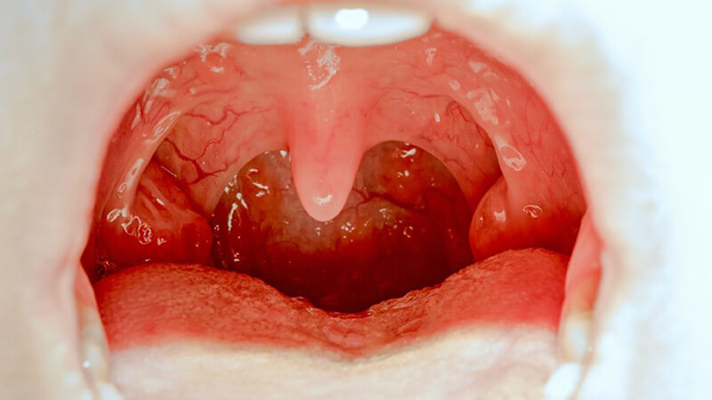 Die Entstehung einer Mandelentzündung und wie man die Tonsillitis erkennen und behandeln kann