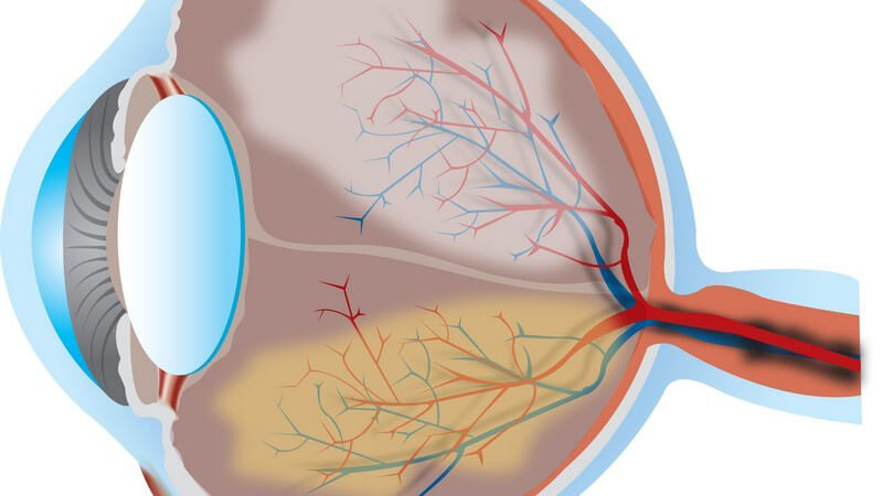 Die Entstehung einer Makuladegeneration und wie man sie erkennen und behandeln kann