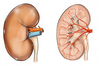 Nierensteine - Ursachen, Symptome und Behandlung der Nephrolithiasis