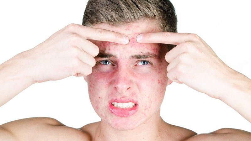 Wissenswertes und Tipps rund um unreine Haut im Gesicht