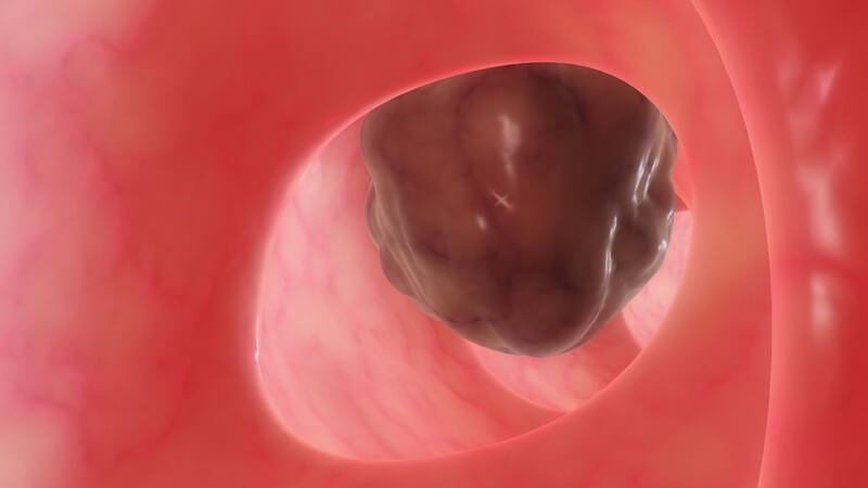 Die Entstehung von Darmkrebs und wie man ihn erkennen und behandeln kann