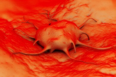 Basaliom - Ursachen, Symptome und Behandlung