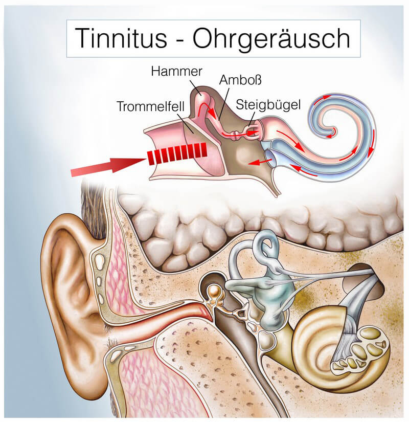 Grafik eines Tinnitus Grafik eines Tinnitus