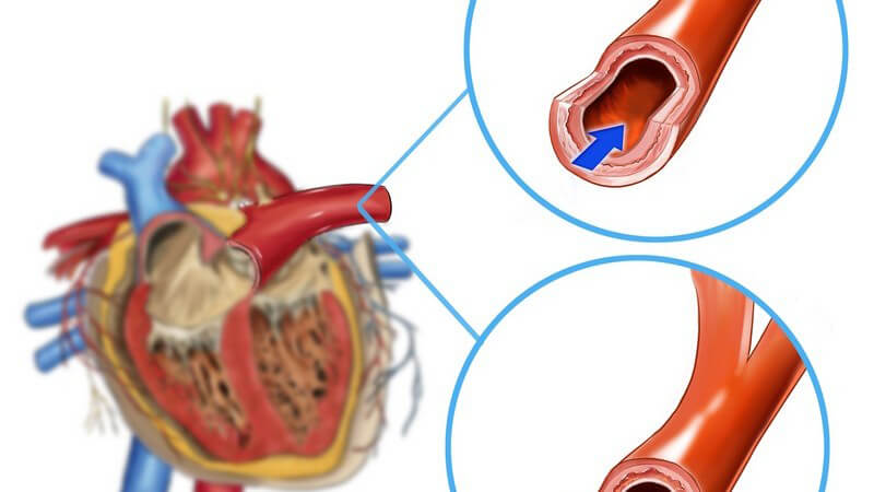 Funktion und Durchführung sowie mögliche Komplikationen der Herzkatheter-Untersuchung zur Diagnose von Herzfehlern