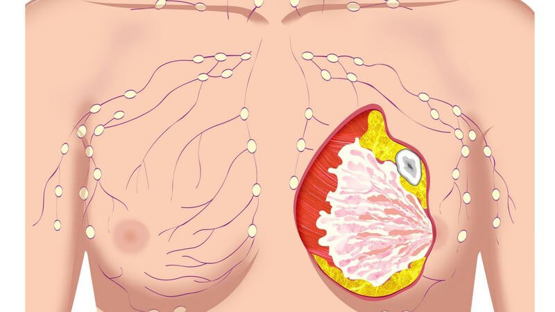 Wissenswertes zur Mammographie