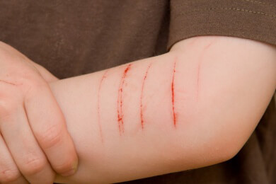 Borderline-Syndrom - Das Leben zwischen den Extremen