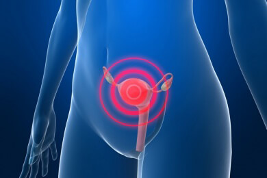 Endometriose - Ursachen, Symptome und Behandlung
