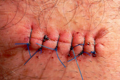 Operationswunden - Ursachen, Symptome und Behandlung