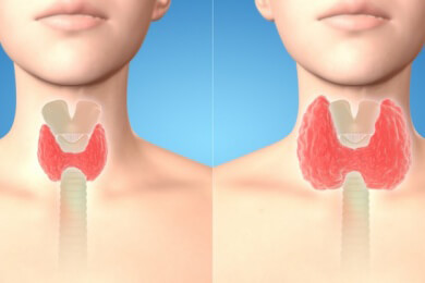 Schilddrüsenvergrößerung - Ursachen, Symptome und Behandlung