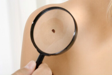 Spinaliom - Ursachen, Symptome und Behandlung