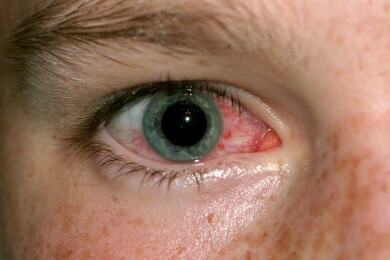 Gerötete Augen - Ursachen und Behandlung