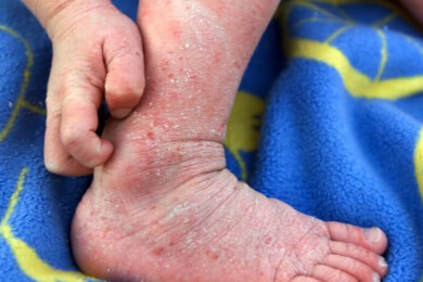 Phototherapie bei Neugeborenengelbsucht - Gelbsucht bei Babys mit Licht behandeln