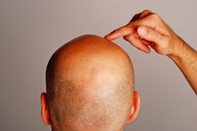 Endlich volles Haar dank Haartransplantation - Methoden, Kosten und Voraussetzungen