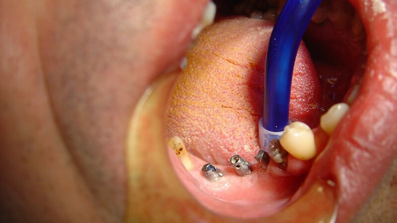 Die Entstehung von Zahnausfall und wie man ihn behandeln und lindern kann