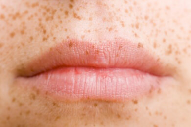 Sommersprossen - Pigmentablagerungen auf der Haut, die vor allem bei Sonnenlicht entstehen