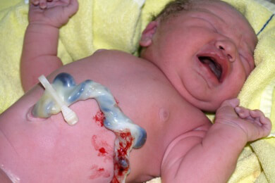 Dammschnitt: Durchführung sowie Vor- und Nachteile