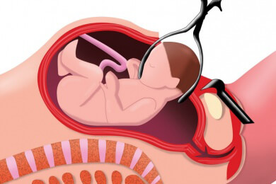 Ablauf vom Kaiserschnitt: geplant, spontan oder Notfall