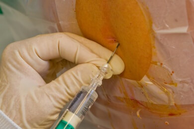 Geburt mit oder ohne PDA? - Vor- und Nachteile der Periduralanästhesie