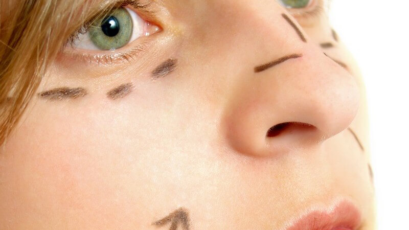 Frauengesicht mit Markierungen vor Schönheitsoperation