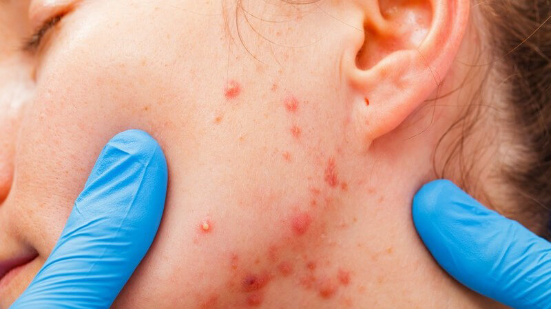 Seitenansicht des Gesichts einer Frau mit schwerer Akne (Pickel), darauf zwei Finger mit blauen Handschuhen