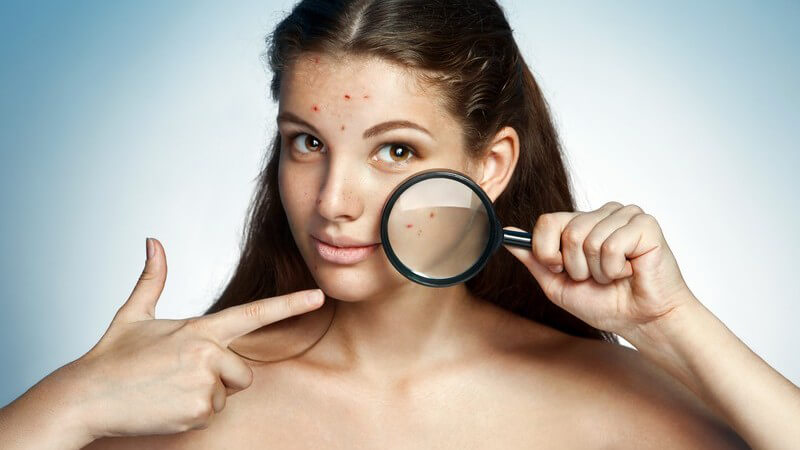 Junge Frau mit vielen Pickeln zeigt auf eine Lupe vor ihrem Gesicht