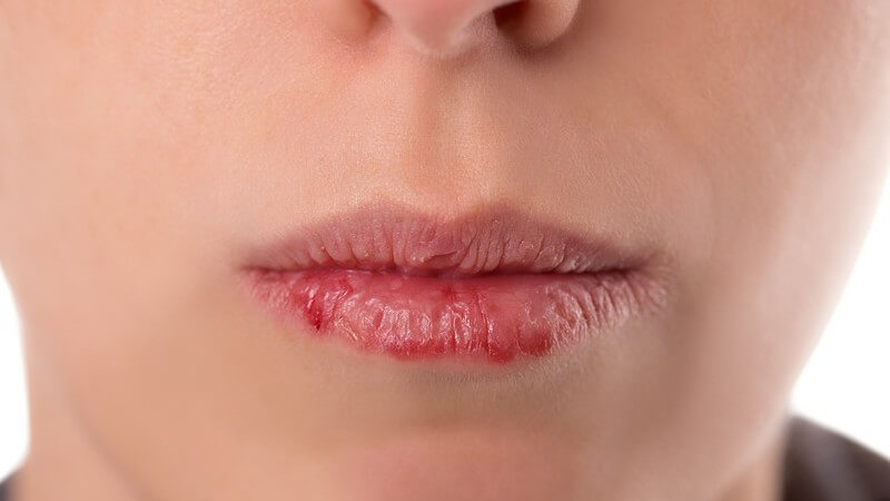 Nahaufnahme der Mundpartie einer Frau mit sehr trockenen, rissigen Lippen