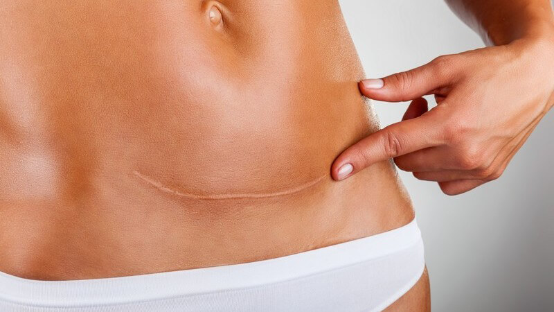 Bauch einer Frau mit Narbe vom Kaiserschnitt