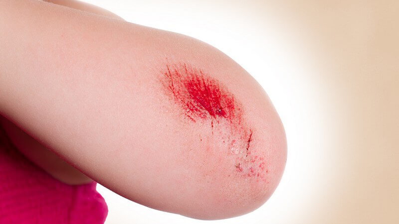 Verletzung Der Haut Mit Fünf Buchstaben www.paradisi.de