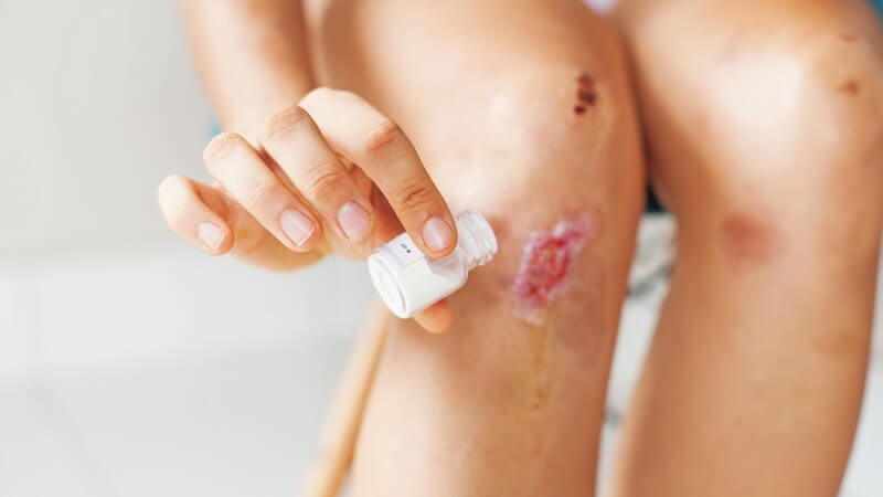 Versorgung einer offenen Schürfwunde am Knie mit Jod