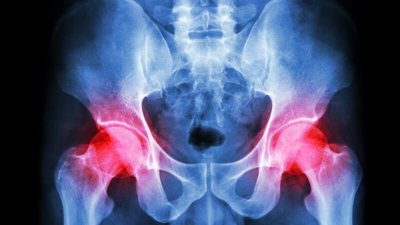 Röntgenbild eines menschlichen Beckens mit Arthritis in der Hüfte, rot gekennzeichnet
