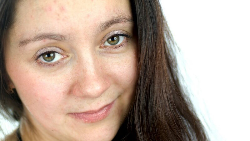 Gesicht einer jungen, dunkelhaarigen Frau, ungeschminkt, mit Problemhaut, Pickeln, Rötungen, unreine Haut, Mischhaut