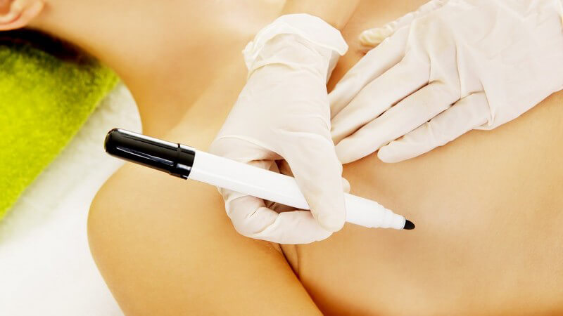 Schönheitschirurgin zeichnet mit einem schwarzen Stift auf der rechten Brustseite einer Frau