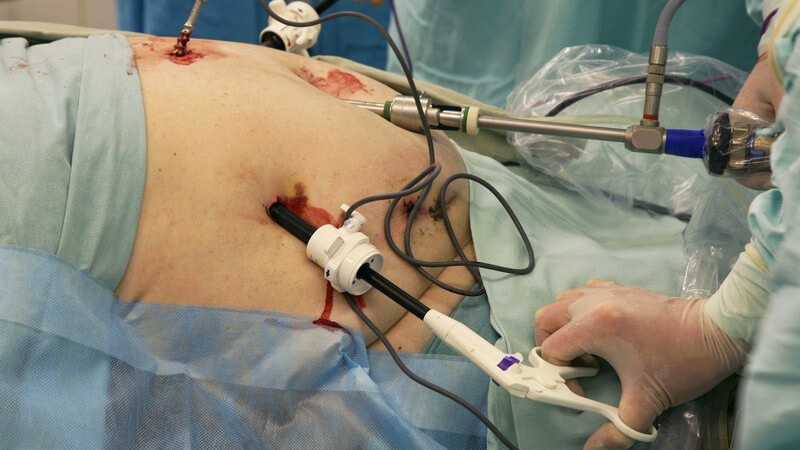 Operation, Fettabsaugung