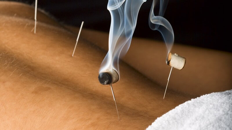 Moxibustion oder Moxa-Therapie auf dem Rücken