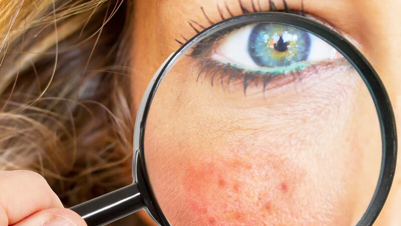 Lupe über Wange und Auge einer dunklelblonden Frau offenbart gerötete und unreine Haut