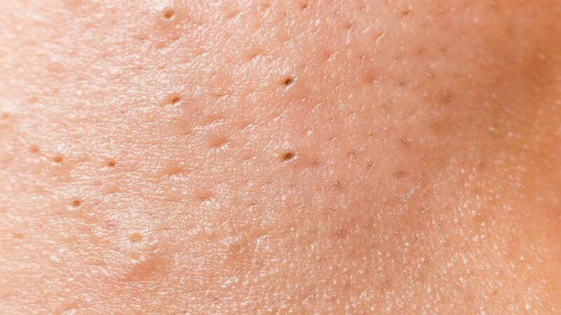 Nahaufnahme einer Gesichtshaut mit vielen schwarzen Mitessern