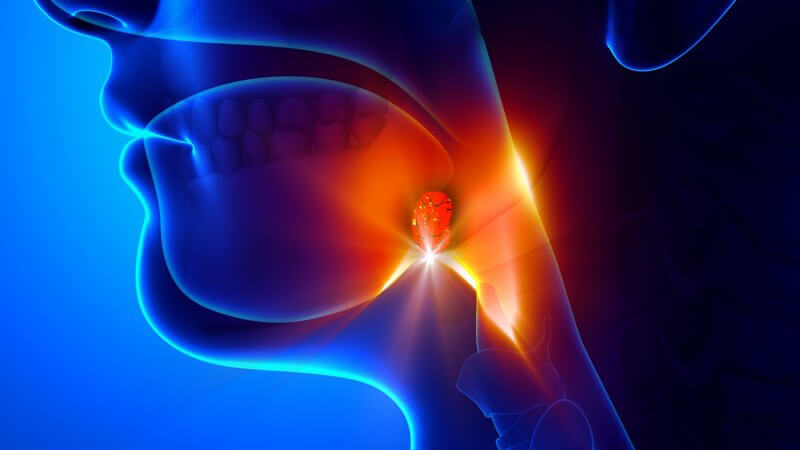 Grafik einer Mandelentzündung (Tonsillitis), Mandeln gelb-rot leuchtend hervorgehoben